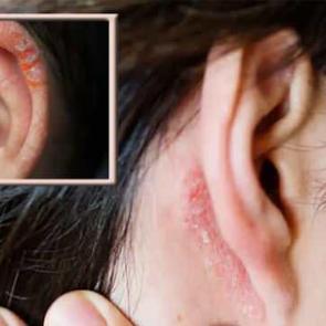 Kulaktaki bu yaygın cilt sorununu sakın g&ouml;z ardı etmeyin!