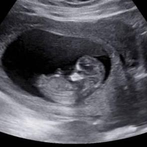 SMA ilk kez anne karnında tedavi edildi