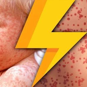 ABD&rsquo;de kızamık salgını: &Ccedil;ocuklar ve gen&ccedil;ler tehlikede!