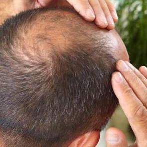 Aşırı sa&ccedil; d&ouml;k&uuml;lmesine iyi gelen y&ouml;ntemler! Sa&ccedil; d&ouml;k&uuml;lmesini &ouml;nlemek i&ccedil;in kalıcı &ccedil;&ouml;z&uuml;m