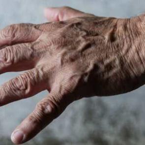 Ellerde beliren mavi damarlar hastalık habercisi mi?