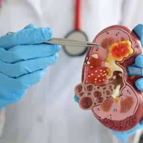 Sessizce ilerliyor, tesad&uuml;fen fark ediliyor! B&ouml;breği korumak i&ccedil;in bu risklerden ka&ccedil;ının