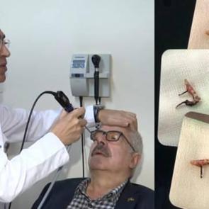 30 yıldır yaşadığı sıkıntının kaynağı burnuna ka&ccedil;an k&uuml;peymiş