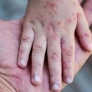 Salgın büyüyor! Bir haftada vakalar yüzde 63 arttı