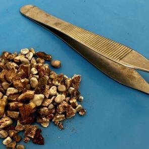 Karın ağrısıyla hastaneye gitmişti! Böbreklerinden 300'den fazla taş çıktı