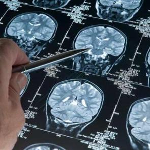 Alzheimer teşhisinde çığır açan gelişme: Yüzde 95 doğrulukla erken teşhis imkanı