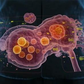 Kolon kanserinden bile sık görülüyor: Apandis kanseri patlaması!