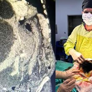 Doktor şaştı kaldı: D&uuml;nya literat&uuml;r&uuml;nde yok! 90 santimetrelik kedi-k&ouml;pek kisti &ccedil;ıkarıldı!