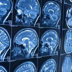 Kovid-19'un gizli hasarı ortaya çıktı: Beyinde küçülmeye yol açtı