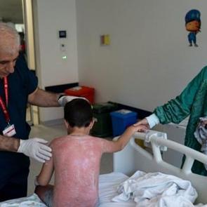 G&uuml;neşin altında 4 saat kalan &ccedil;ocuk, ikinci derece yanık oldu