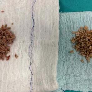 84 yaşındaki hastanın mesanesinden çıktı!