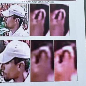 Kulağı 8 yıl sonra gerçeği ortaya çıkardı! 17 milyon lira tazminat başvurusu