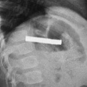 Anne babalar dikkat! 3 yaşındaki çocuğun boğazından çıkarıldı: Tam 19 tane