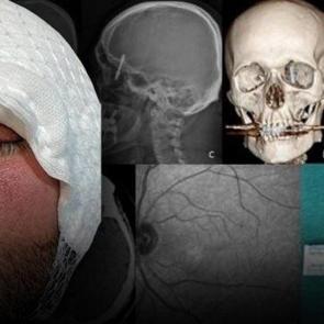 Diş tedavisi için gitti hayatı kâbusa döndü! Çenesini delip kafatasına saplandı