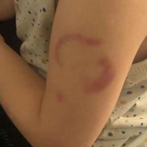 &Ouml;ğrencisinin kolunu ısırdığı iddia edilen &ouml;ğretmenin savunması ortaya &ccedil;ıktı 