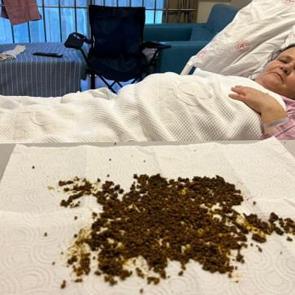 Doktorlar şoke eden vaka: Safra kesesinden 20 binin üzerinde taş çıktı! İşte o görüntü...