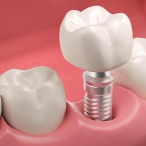 MHP'den milyonları sevindiren kanun teklifi: İmplant SSK kapsamına girebilir