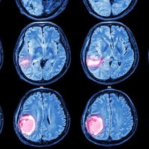 Beyin t&uuml;m&ouml;rlerinde 3 kritik sinyal!