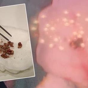 Yıllarca fark etmedi, estetik ameliyatta ortaya &ccedil;ıktı: Burunda rinolit şoku!