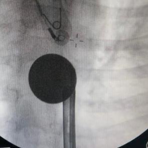 G&ouml;ren inanamadı! 8 yaşındaki &ccedil;ocuğun boğazından &ccedil;ıkartılan şaşırttı