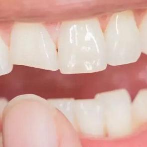 Siz de uzak durun: Dişlerinizi sinsice eritiyor, b&uuml;y&uuml;k zarar veriyor!