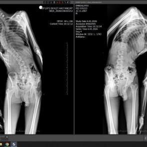 Mersin'de &ouml;nemli başarı: 18 yaşındaki gencin boyu ameliyatla 4 santimetre uzadı