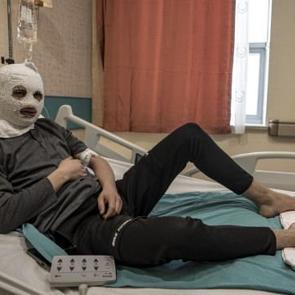 &Ccedil;akmak gazı faciası! V&uuml;cudu yandı