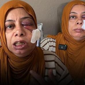 Hatay'da korkun&ccedil; kaza: Dişleri kırıldı, y&uuml;z&uuml;ne 14 dikiş atıldı 