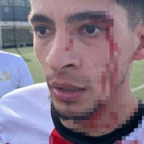 Yeşil sahada kan g&ouml;vdeyi g&ouml;t&uuml;rd&uuml;: 3 futbolcu hastanelik oldu