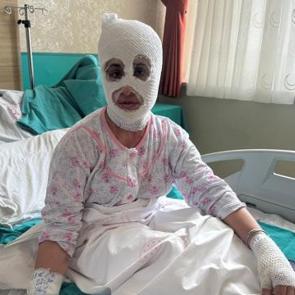 İftar hazırlığında facia: D&uuml;d&uuml;kl&uuml; tencere y&uuml;z&uuml;ne patladı!