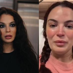 Doktor hatası y&uuml;z&uuml;nden 6 kez ameliyat oldu! Aslı Bekiroğlu son durumunu paylaştı