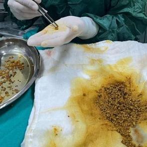 Karın ağrısı şikayetiyle gitti, v&uuml;cudundan 2 bin 67 tane taş &ccedil;ıktı