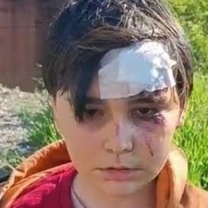 K&uuml;tahya'da başıboş k&ouml;pek dehşeti! 2 &ccedil;ocuk saldırıya uğradı