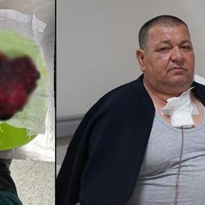 Bilecik'te ilgin&ccedil; vaka: Boynundaki 542 gramlık kitle &ccedil;ıkartıldı 