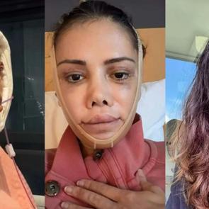 Y&uuml;z nakli ge&ccedil;iren Didem Ceran ateş p&uuml;sk&uuml;rd&uuml;: 'İnsanlar neden yaraya tuz basar?'