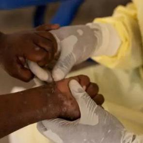 G&uuml;ney Afrika&rsquo;da son 5 haftada 13 kişide M &ccedil;i&ccedil;eği vakası kaydedildi