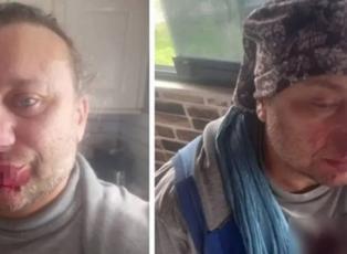  Yoğun bakımdan &ccedil;ıkan Onur Akay pitbull dehşetini anlattı: '&Ouml;l&uuml;mden d&ouml;nd&uuml;m'