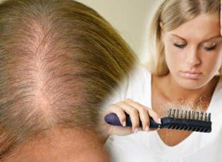 Saç dökülmesine karşı en etkili yöntem nedir? Saç dökülmesini durduran maske tarifleri