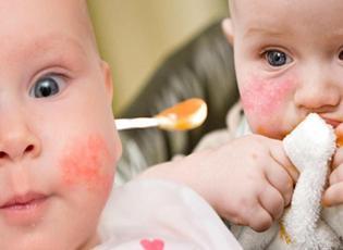 Alerji olan bebek ne yemeli? Alerjik bebekler için alternatif besinler nelerdir?