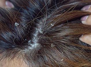 Saç derisi kaşıntısı nasıl geçer? Saç derisinde kaşıntı neden olur ve kaşıntıyı gideren yöntem