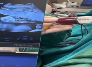 Anne karnındaki bebeğe kan nakli yapıldı
