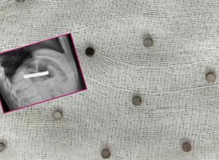 Midesinden 19 mıknatıs çıkarılan çocuk doktorları şoke etti!