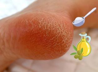 Çatlamış topuklara mucize çözüm! Sadece 2 malzeme ile yumuşacık oluyor