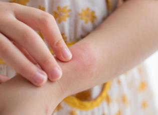 Kaşıntı deyip ge&ccedil;meyin: &Ccedil;ocuklarda 6 haftadan fazla s&uuml;r&uuml;yorsa dikkat!