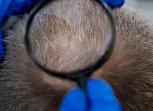 Erkek tipi sa&ccedil; d&ouml;k&uuml;lmesinde &ccedil;ığır a&ccedil;an adım: Clascoterone!