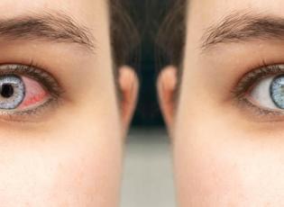 Uzmanı uyarıyor: Kış aylarında soğuk hava ve kapalı ortamlar, g&ouml;z sağlığını tehdit ediyor!