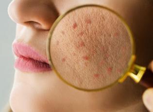 Yetişkinlerde akne alarmı: Uzman isim tetikleyen fakt&ouml;rleri sıraladı