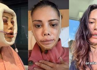Y&uuml;z nakli ge&ccedil;iren Didem Ceran ateş p&uuml;sk&uuml;rd&uuml;: 'İnsanlar neden yaraya tuz basar?'