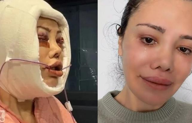 Y&uuml;z nakli ge&ccedil;irmişti! Didem Ceran k&ouml;t&uuml; haberi duyurdu