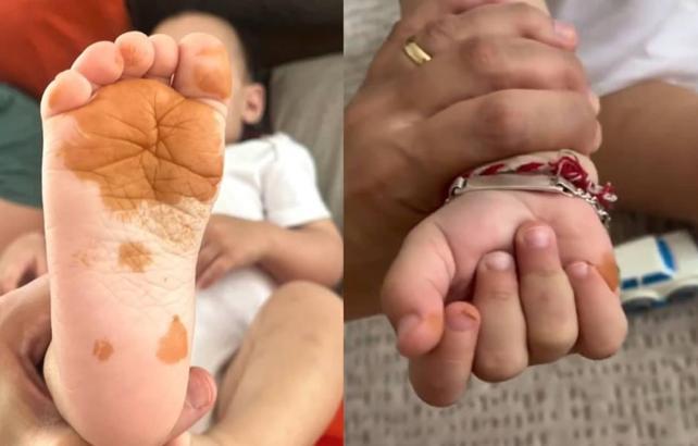 Sosyal medyada g&uuml;ndem oldu! &Ccedil;ocuğunun el ve ayaklarındaki renk değişiminin nedeni şaşırttı